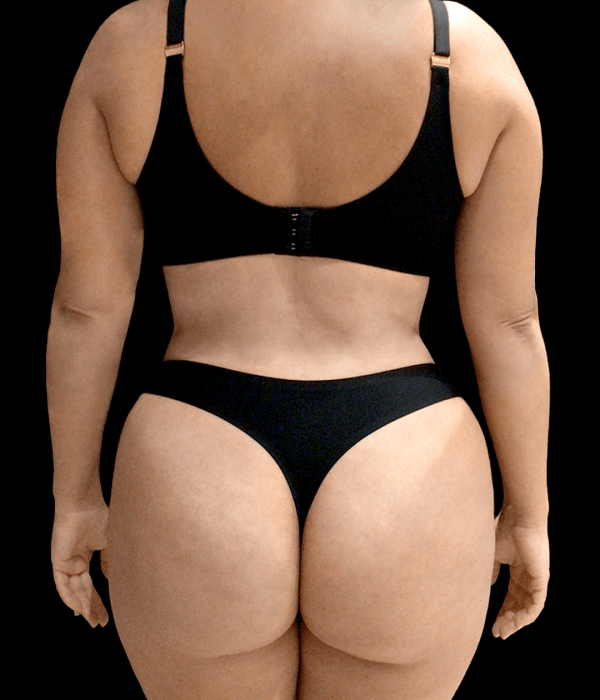 Augment my buttocks with fat
