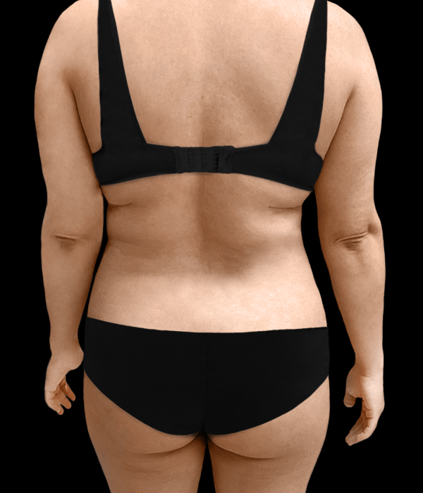 Augment my buttocks with fat