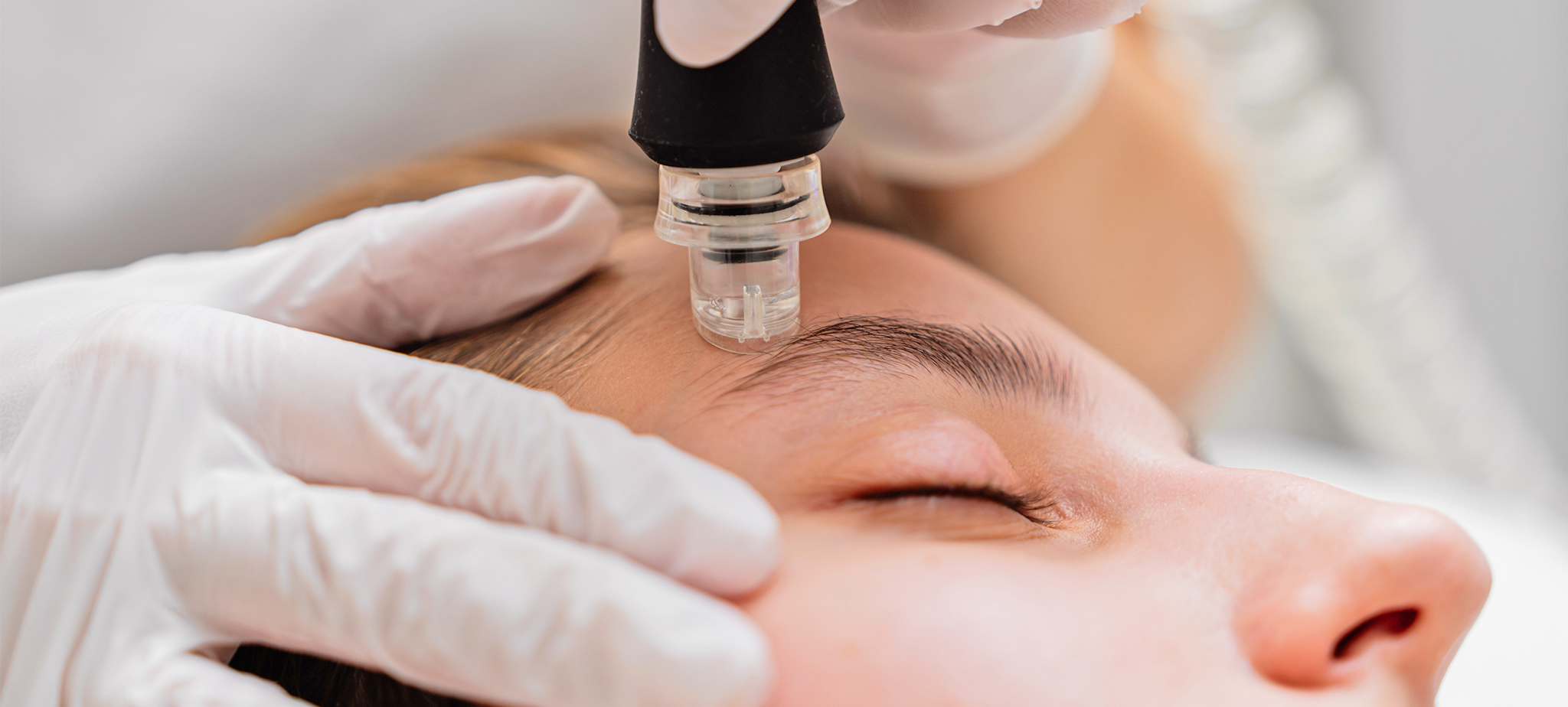 Microdermabrasion