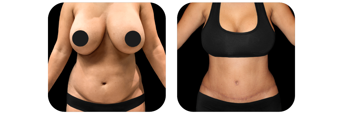 Tummy Tuck