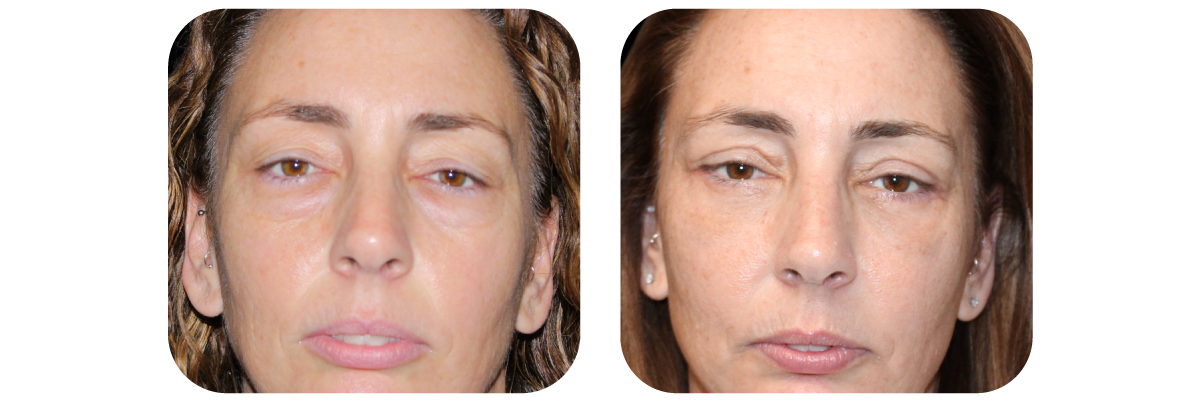 Blepharoplasty