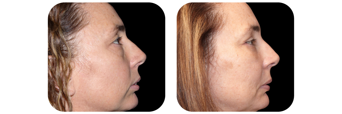 Blepharoplasty