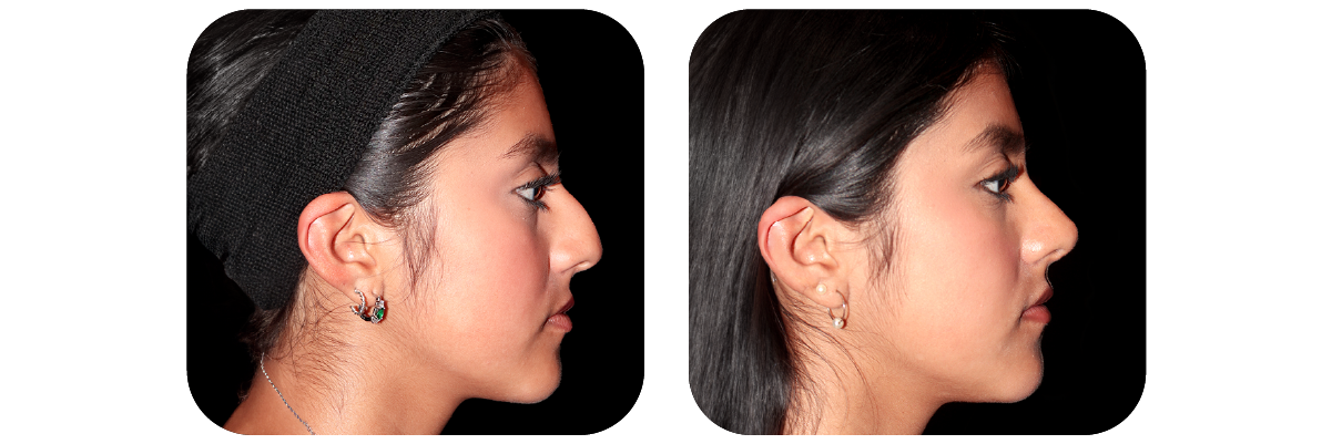 Rinoplastia
