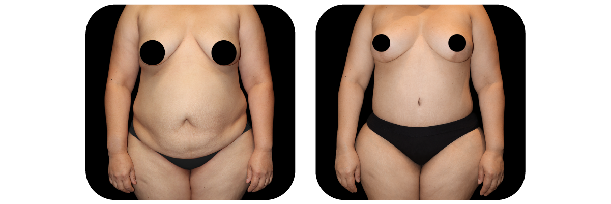 Tummy Tuck