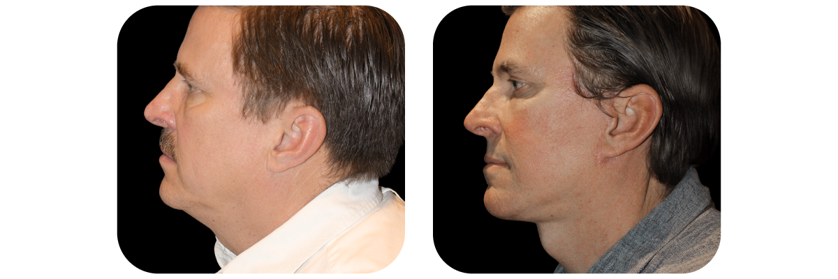 Necklift