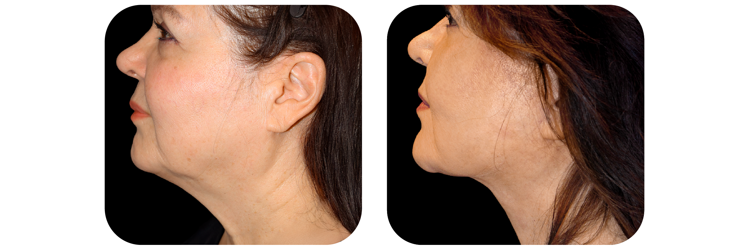 Necklift