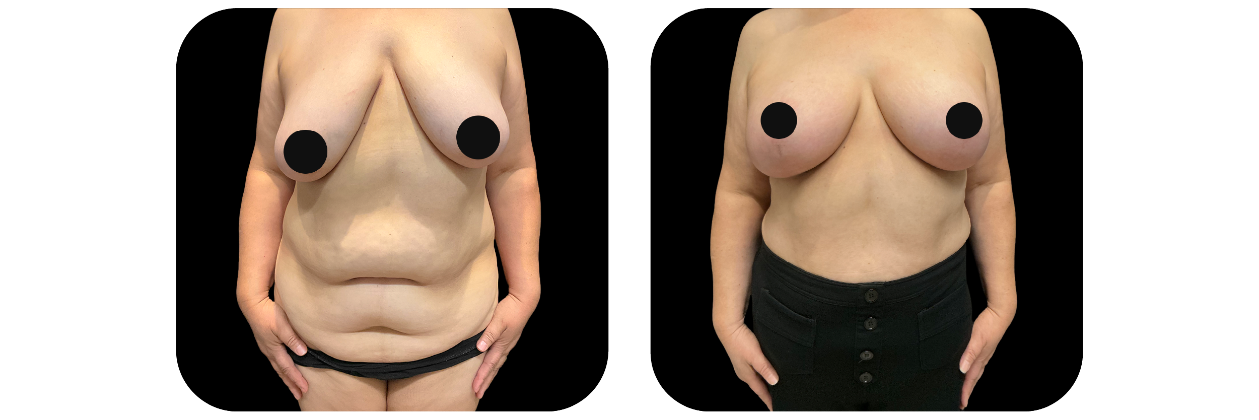 Breast Lift