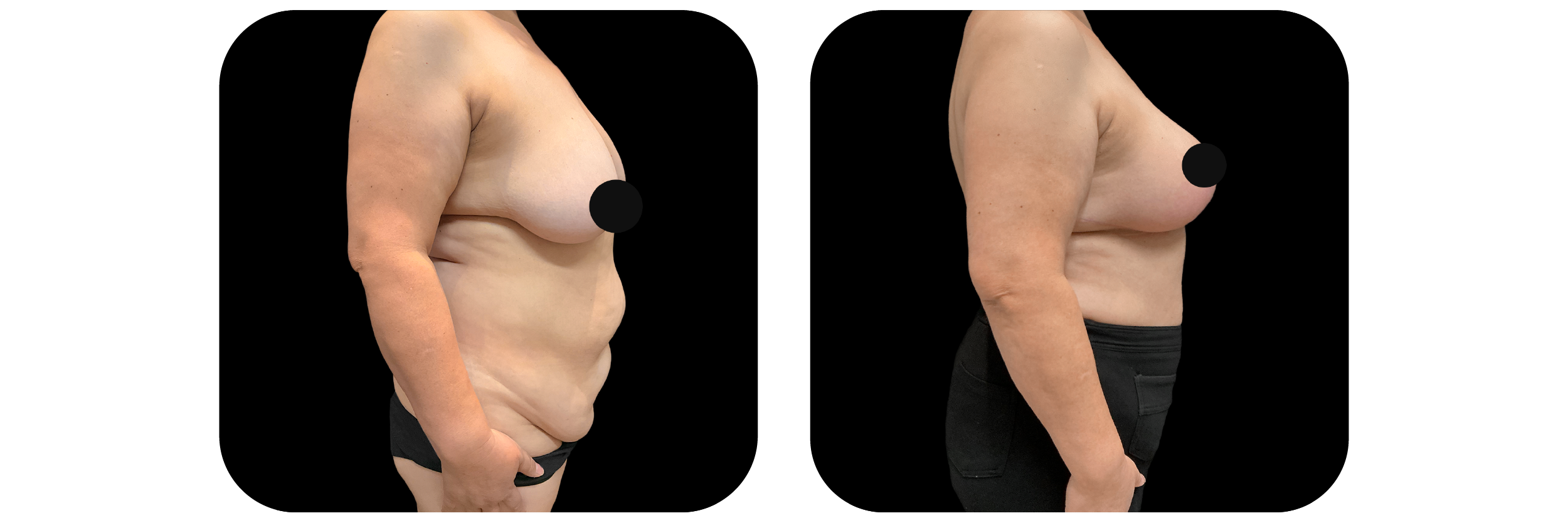 Breast Lift