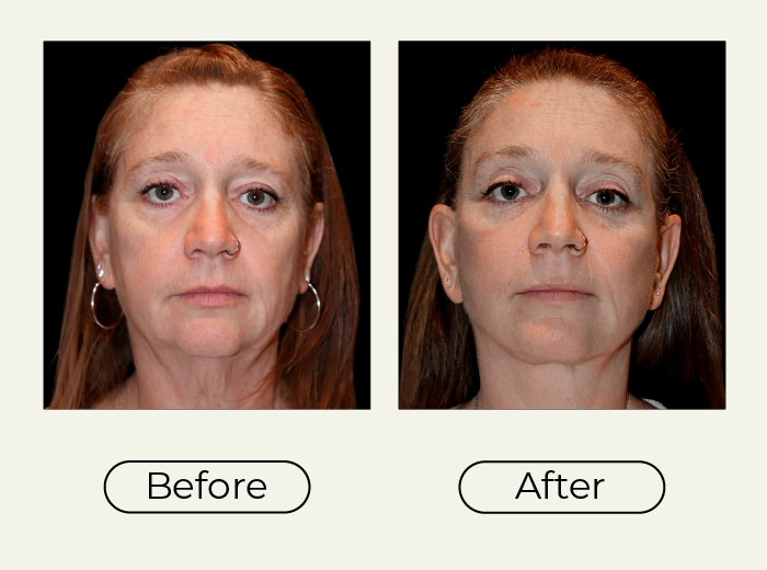 Side-by-side before and after photos of a woman's face, left labeled Before, right labeled After, showing cosmetic improvement and a more refreshed jawline after treatment.
