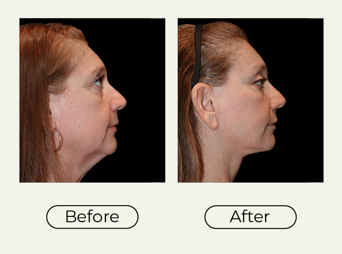Side-by-side profile photos of a woman before and after cosmetic neck/face contouring, showing a slimmer jawline in the After image.
